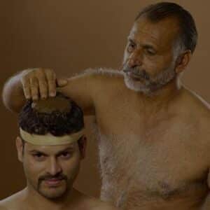 migraine treatment in ayurveda